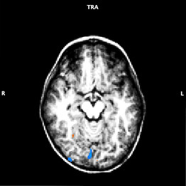Das Gehirn eines Kindes, welches die Handschrift praktiziert, weist erhöhte Aktiviät in einem Schlüsselbereich des Gehirns auf (blau markiert), welches ein Indiz dafür ist, dass Lernen stattgefunden hat.